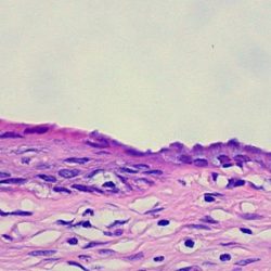 Squamous metaplasia cervix mag high uterine sm endocervical